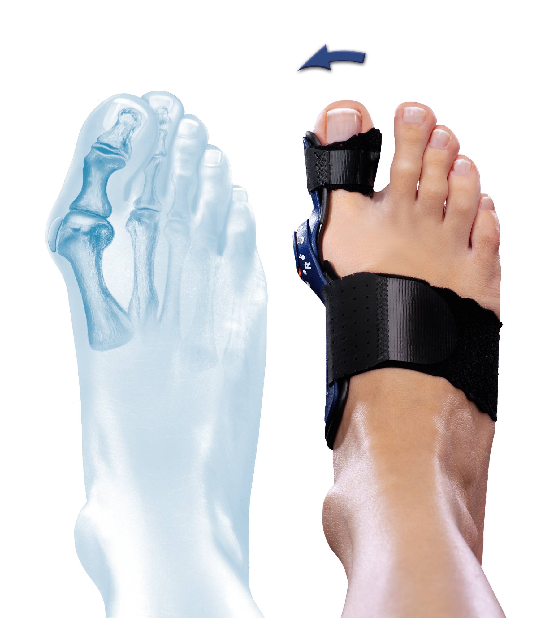 Vbočený palec (Hallux Valgus): Jak předejít operaci a ulevit si od bolesti? 